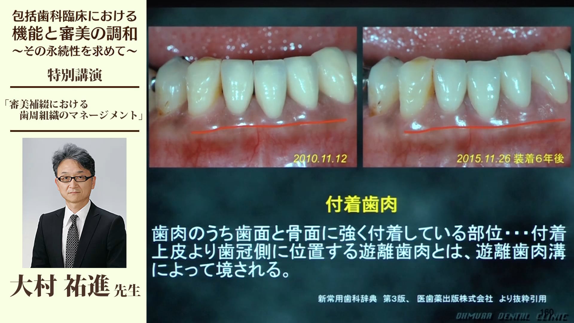 審美補綴における歯周組織のマネージメント #3