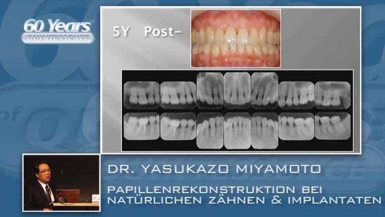 Reconstruction of lost papillae for natural teeth and implants