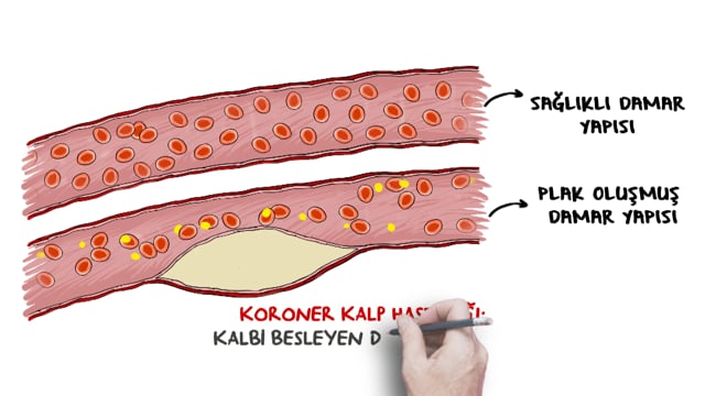 Kalp Krizi Nedir ve Belirtileri Nelerdir?