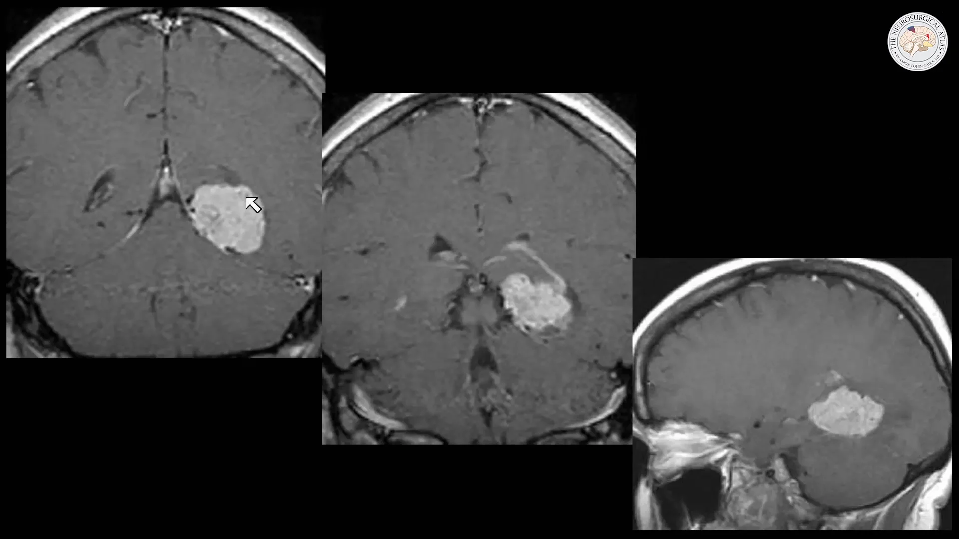 健康・医学 Meningiomas, Part II (Volume 170) i2 Frontiers | Identification and Management of Aggressive