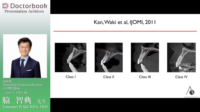 Immediate Provisionalizationの診断と臨床