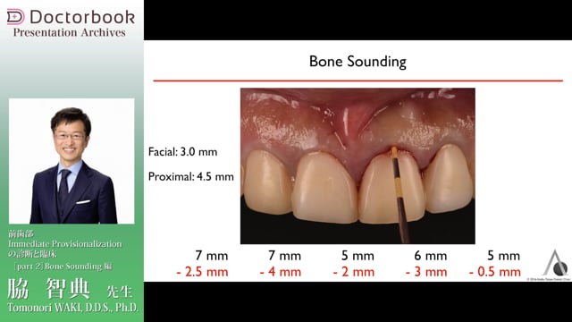 #2 BoneSoundingの重要性