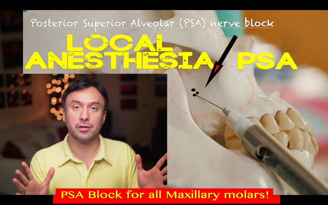 Painless Maxillary Molar Anesthesia using the PSA Technique Real