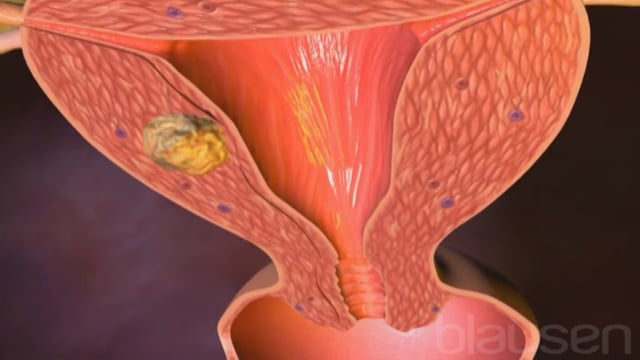 Menstruation smerter i underlivet udebleven