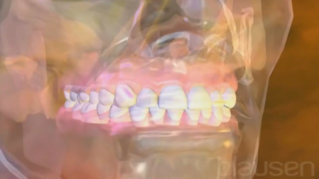 Tand gør ondt rodbehandlet Rodbehandling af