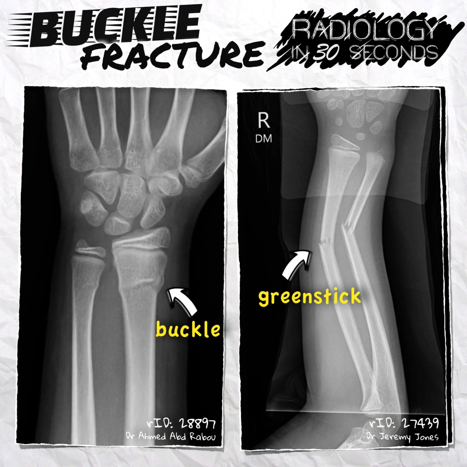 Buckle fracture on Vimeo