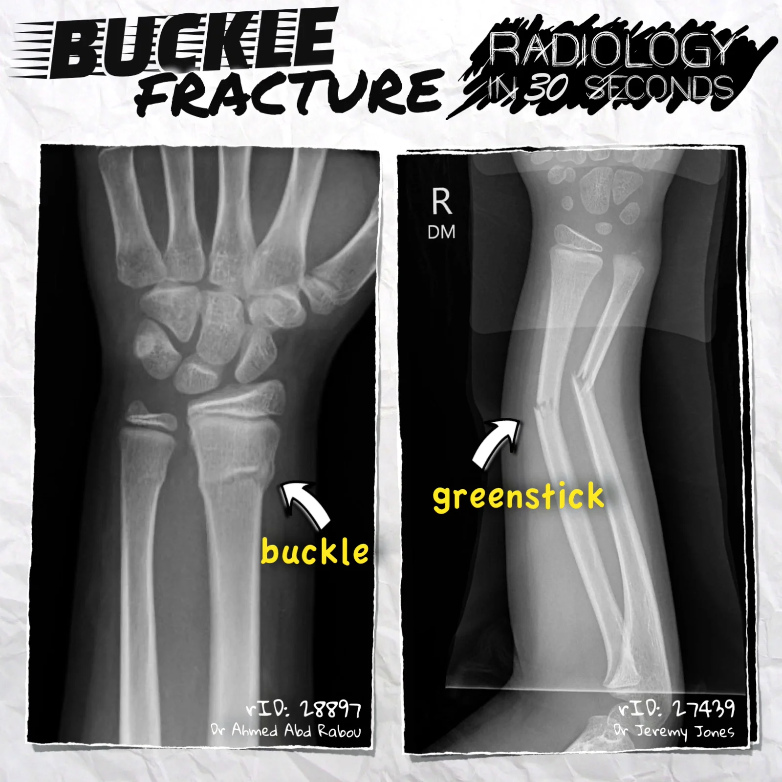 Buckle fracture outlet