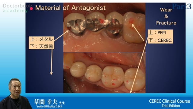 CEREC Clinical Course（CCC）トライアルエディション #3