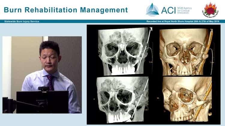 11 Burns reconstruction surgery Dr Jeon Cha