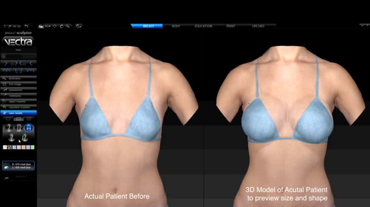 3D Breast Augmentation Model Rendering of Actual Patient