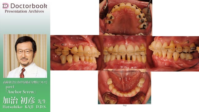 3 LOT（限局矯正）とimplant | Doctorbook academy (ドクターブックアカデミー)