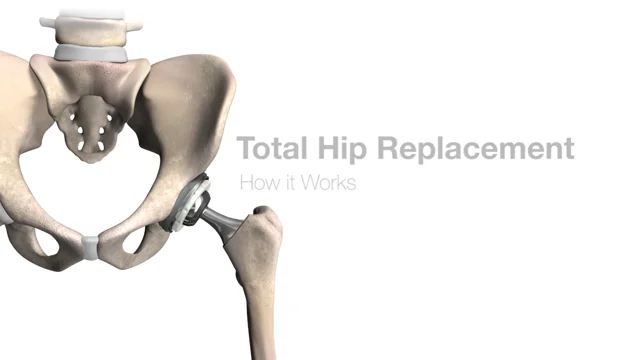 Total Hip Replacement - OrthoInfo - AAOS