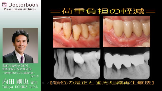 関節円板前方転位を伴う顎関節症と咬合性外傷 | Doctorbook