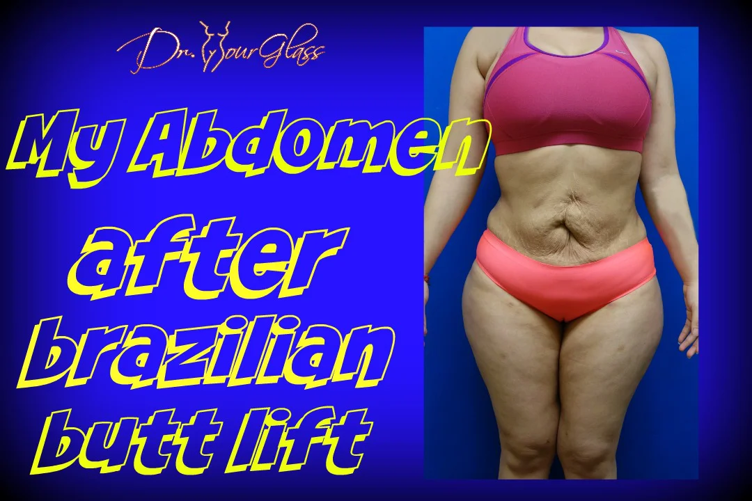 How your abdomen will look after fat harvesting for a Brazilian butt lift.  on Vimeo