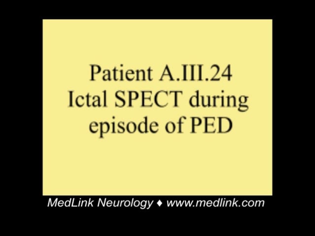Paroxysmal exercise-induced dyskinesia in GLUT1 deficiency syndrome
