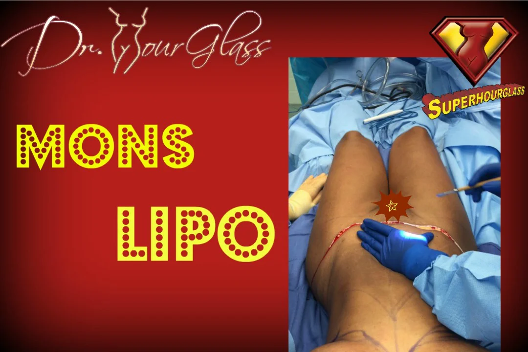 Liposuction Fupa. Houston, Austin, Dallas, San Antonio on Vimeo