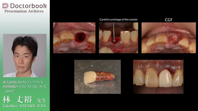 インプラント周囲組織のマネジメント | Doctorbook academy (ドクター 