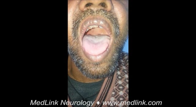 Palatal myoclonus (2)