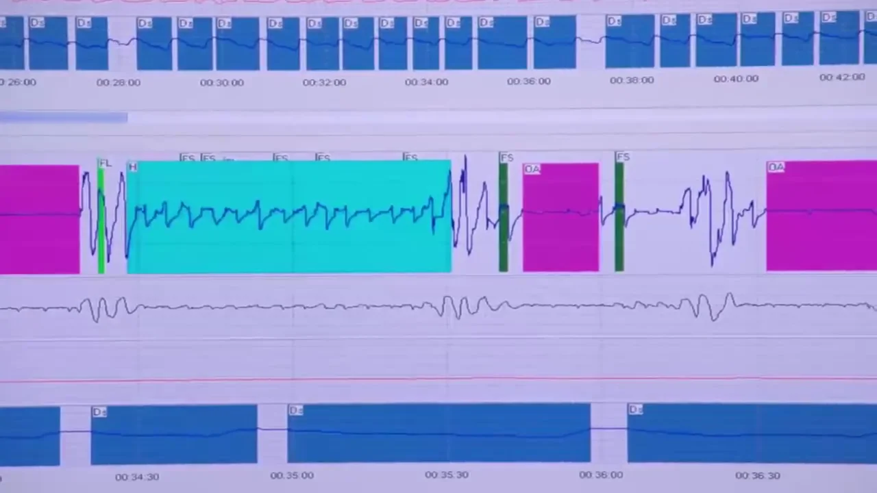 How to use the ApneaLink™ Air Home Sleep Testing Device (720p) on Vimeo
