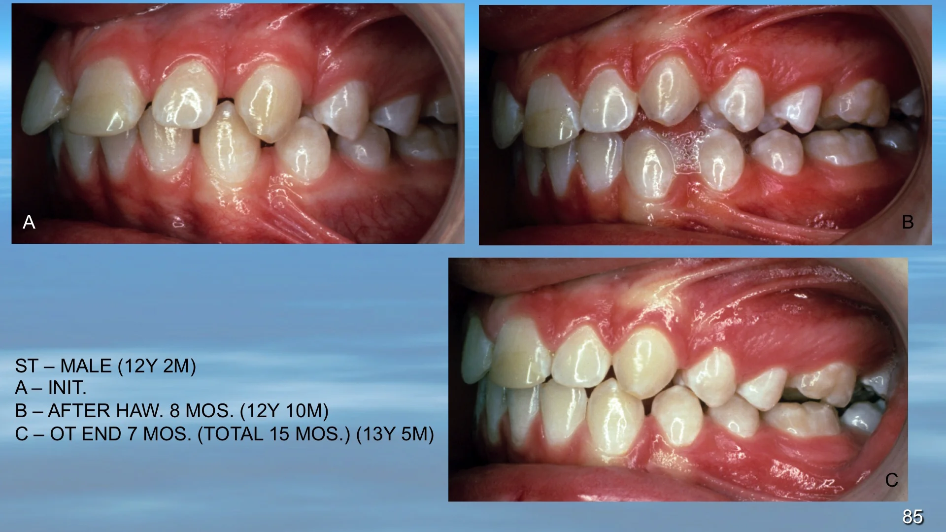 Disc 2 Og, Segment 1 - Spacing And Cross Bite, Diastema, Hawley 