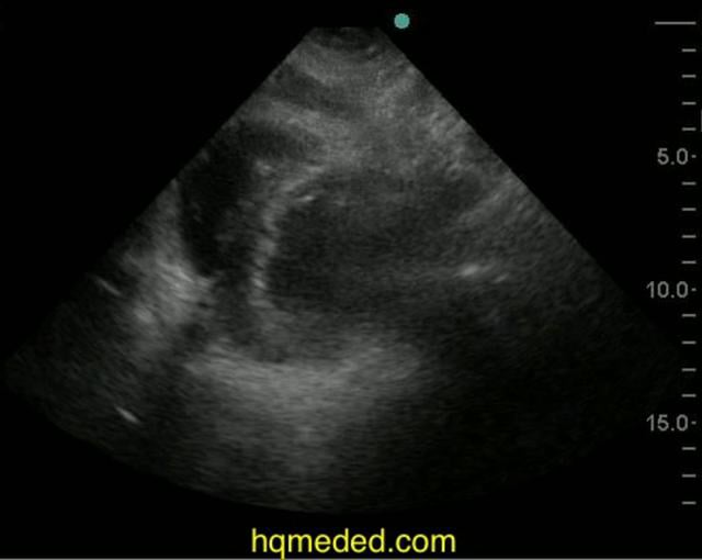 Ultrasonography - Tako-tsubo syndrome on Vimeo