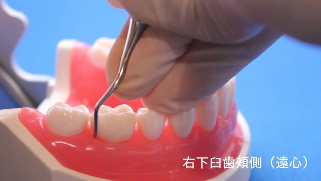 【ユーザー限定】スケーリング基本操作 右下臼歯編
