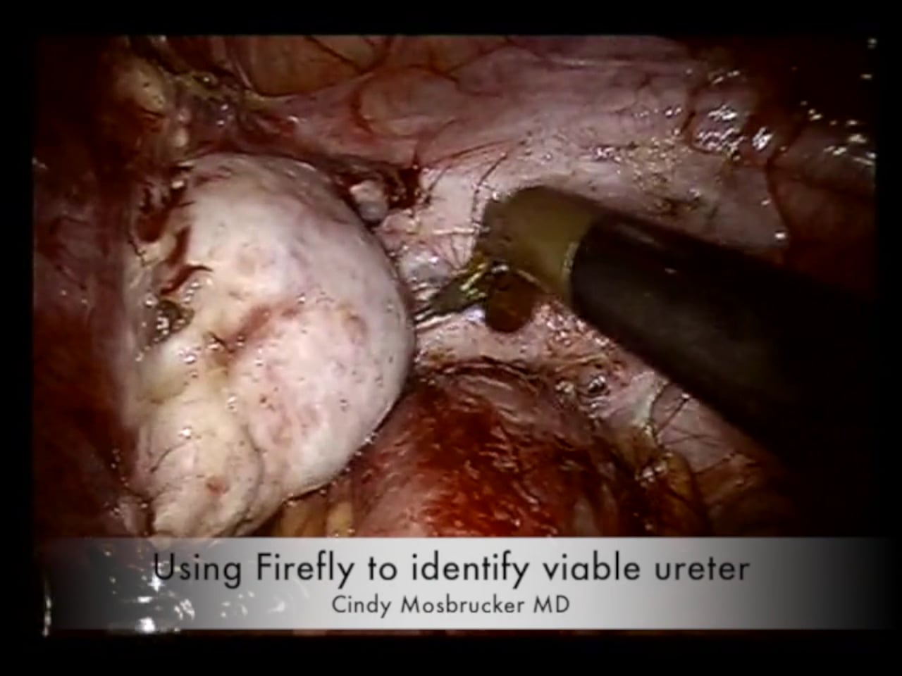 FIrefly Ureter