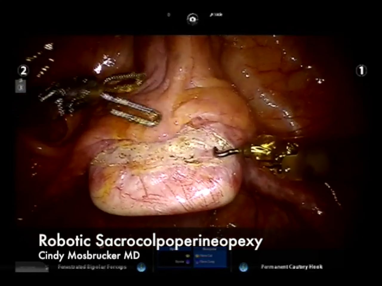 Robotic Sacrocolpoperineopexy