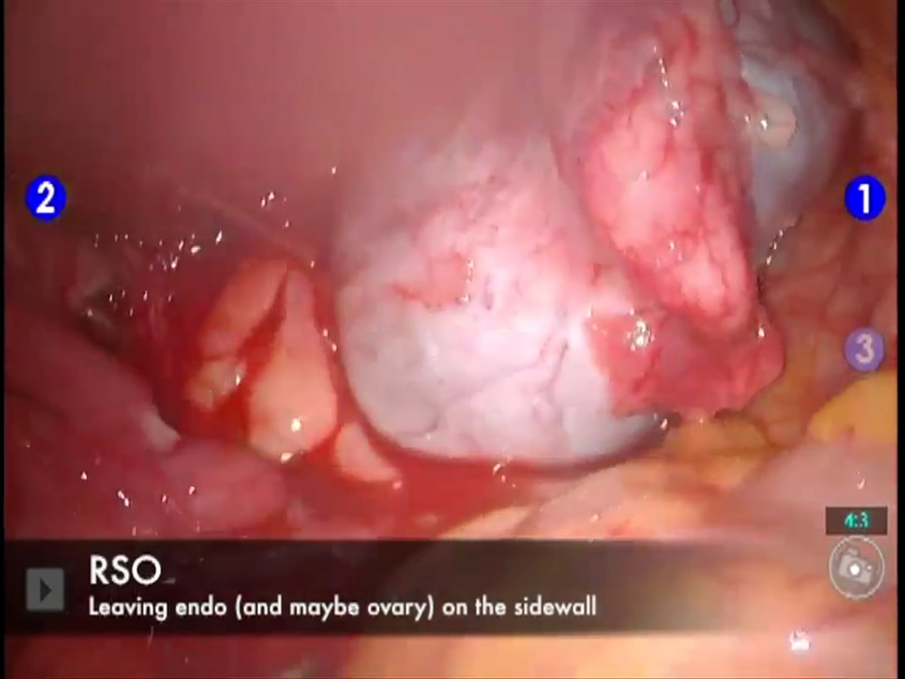 RSO leaving ovary on sidewall