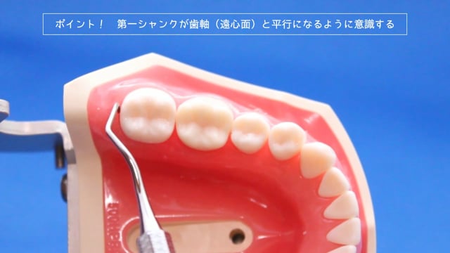 【ユーザー限定】スケーリング応用操作最後臼歯遠心編