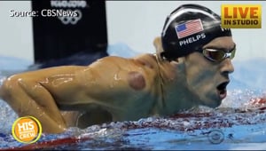 Michael Phelps Inspires Cupping Craze