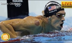Michael Phelps Inspires Cupping Craze