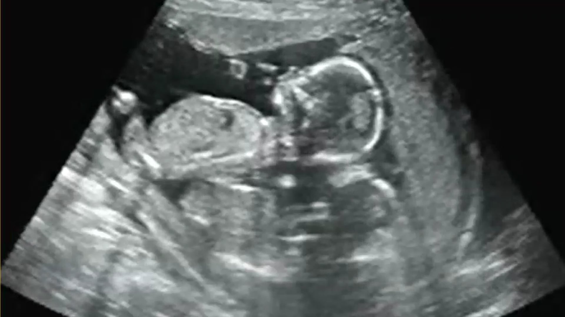TWINS 3D 4D GENDER REVEAL ULTRASOUND!! At A New Conception 3D Ultrasound Studio in Hanover, Ma