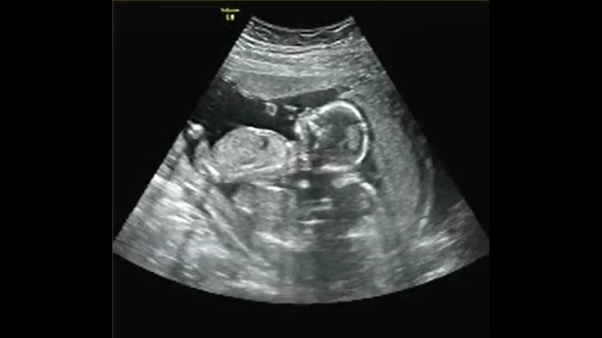 TWINS 3D 4D GENDER REVEAL ULTRASOUND!! At A New Conception 3D Ultrasound Studio in Hanover, Ma