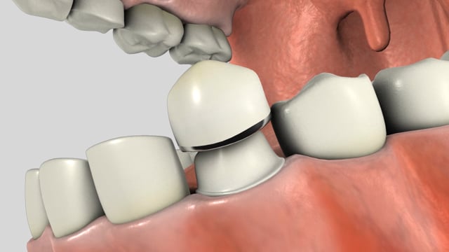 Porcelain Fused To Metal Crown (PFM)