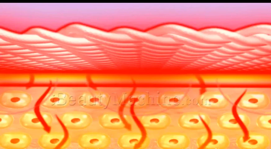 Ultralift 360P™ | Most Advanced and Super Efficient HIFU Ultralift 360P™ | Most Advanced and Super Efficient HIFU