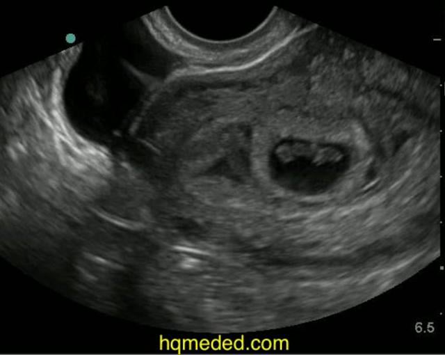 Ultrasonography - Early Intrauterine Pregnancy On Vimeo