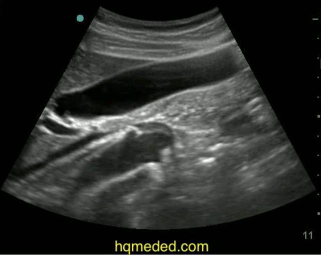 Ultrasonography - normal gallbladder, aorta on Vimeo