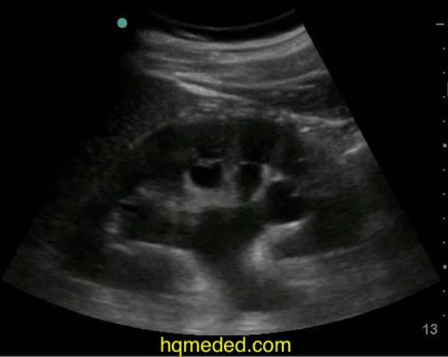 hydronephrosis grading ultrasound