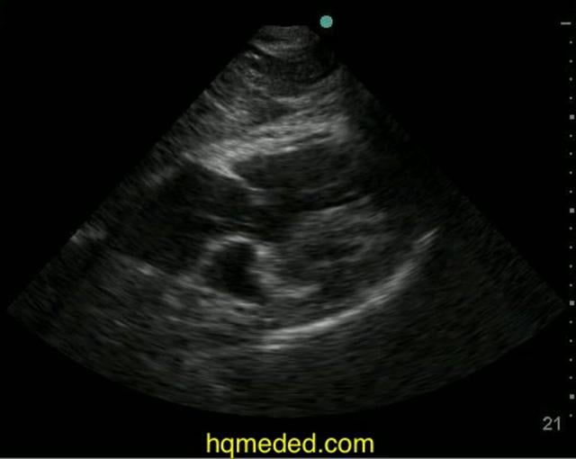 Ultrasonography - pulmonary embolism on Vimeo