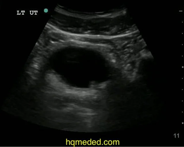 Ultrasonography - Stone in the uvj on Vimeo