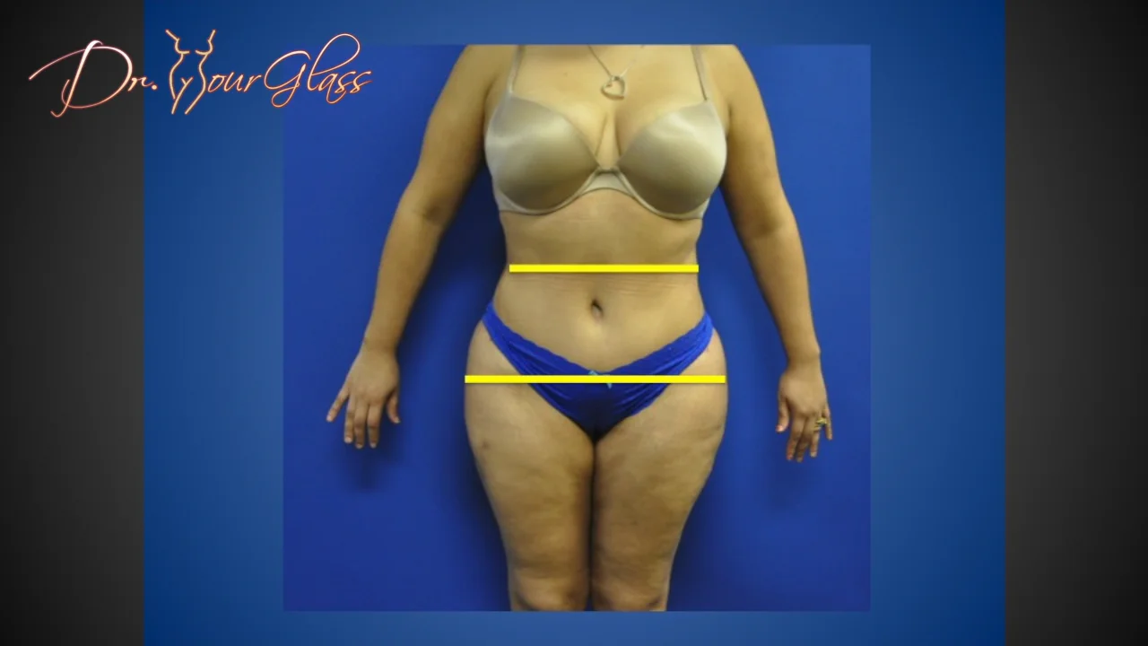 Revision tummy tuck - Hourglass Tummy Tuck