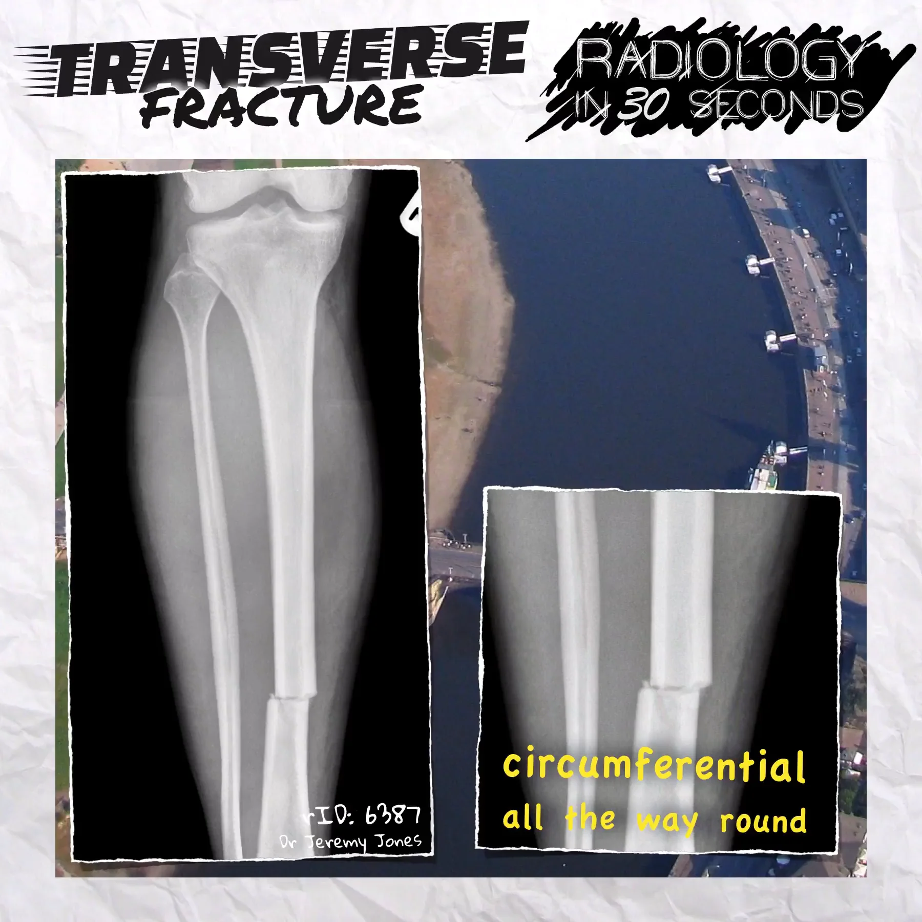transverse fractures