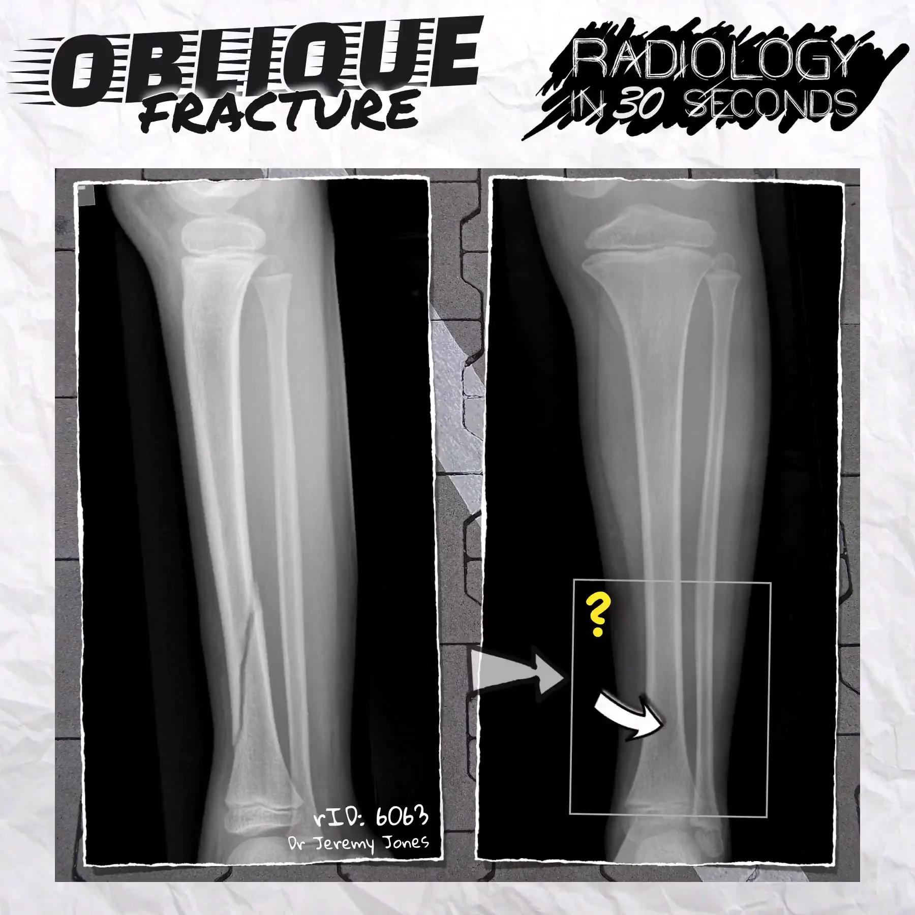 Oblique fracture on Vimeo