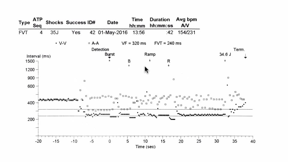 Defibrillation for VF and VT when ATP fails