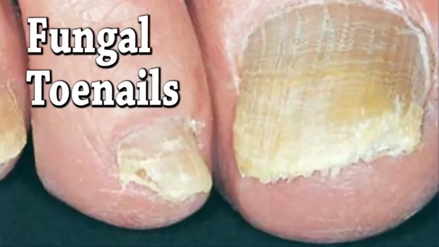 Types of on sale toenail fungus