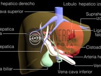 Cistoadenoma Hepatobiliar 360º 3D
