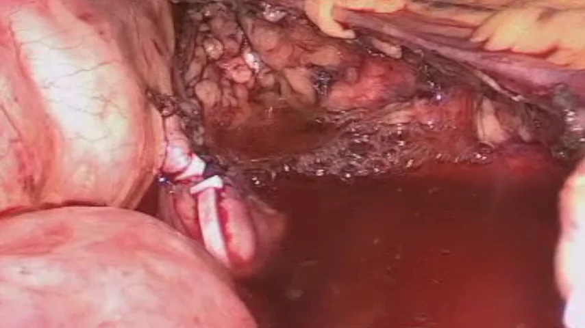 Ooforectomía derecha Video Laparoscopica 