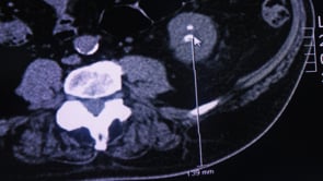 NEFROLITECTOMIA PERCUTANEA: CONSEJOS Y TRUCOS