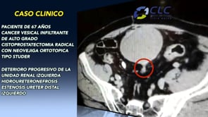 REIMPLANTE URETERAL ASISTIDO POR ROBOT EN ESTENOSIS URETEROINTESTINAL DE NEOVEJIGA ORTOTOPICA TIPO STUDER